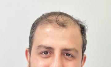 Dr Resul Yaman Hair Clinic - 4790 Grafts 2 Years Result