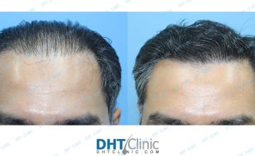 Dr. Damkerng Pathomvanich (DHT Clinic) / FUE 2,220 grafts, 13 months post op