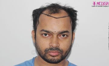 Dr. Suneet Soni - 5000 Grafts, Combine FUT + FUE + Beard Technique, NW-V