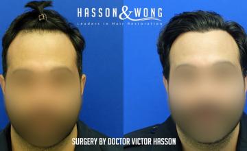 Dr. Hasson / 2,500 grafts / FUE / Hairline / 1 Year Post-op