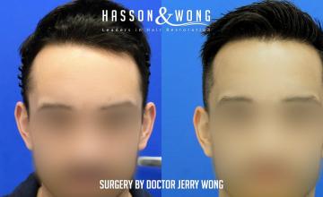 Dr. Wong /1300 Grafts/ Hairline/temple points/ FUE/ 1 Session/ 1 year post-op