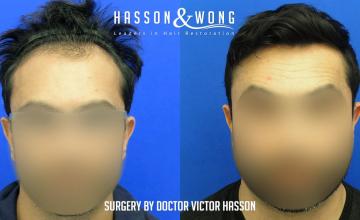 Dr. Hasson /3058 Grafts/ FUE/ 1 Session/ 20 months post-op