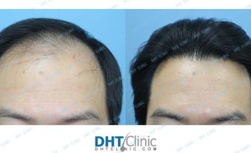 Dr. Damkerng Pathomvanich (DHT Clinic) / Combination of FUT and FUE  (3,731 grafts), 2 years and 2 months post op