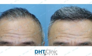 Hair Restoration with Combination FUT and FUE from the Scalp and the Beard (3,953 grafts)