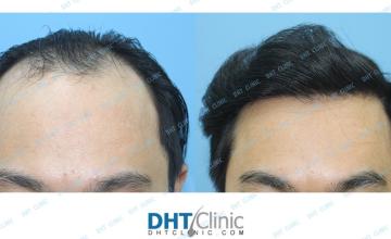 Dr. Damkerng Pathomvanich (DHT Clinic) / Combination of FUT and FUE 3,518 grafts, 1 year post op