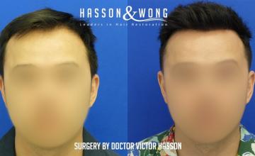 Dr. Hasson / 3055 grafts / Dense pack / FUE / frontal zone / 1 year post-op