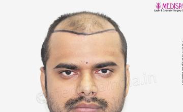 Dr. Suneet Soni - 4486 Grafts, 2 Years Result, Combine FUT + FUE Technique, NW : V-VI