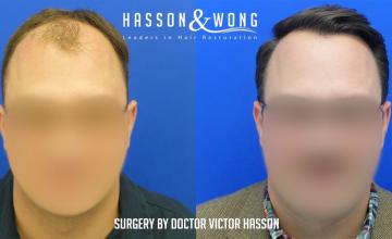 Dr. Hasson / 4,511 grafts / FUE / Frontal zone /mid / 3 years post-op