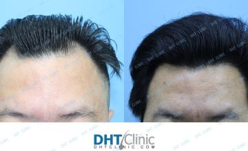 Dr. Damkerng Pathomvanich (DHT Clinic) /Hairline FUE 1,910 grafts, 6 months post op