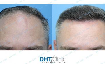 Dr. Damkerng Pathomvanich (DHT Clinic) / FUE 3,380 grafts / post-op 10 months