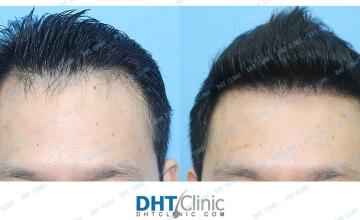 Dr. Damkerng Pathomvanich (DHT Clinic) / Restoration of frontal hairline and crown/ Combo 3137 grafts (2588 FUT and 594 FUE) / post-op 7 months
