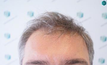 Dr. Rafael de Freitas - 5.413 Grafts / 12.982 Hairs - FUE