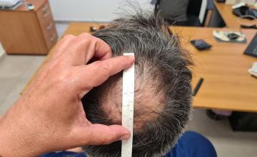 Crown Result – 5 months After – 2730 FUE Grafts – HDC Hair Clinic