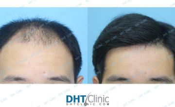 Dr. Damkerng Pathomvanich (DHT Clinic) / Combination of FUT and FUE 4,092 grafts, 11 months post op
