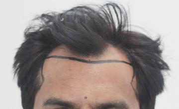 Dr. Suneet Soni - 3200 Grafts, Combine FUT + FUE Technique , NW-IV