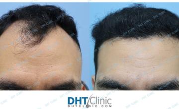 Hairline Restoration with FUE 3,073 grafts