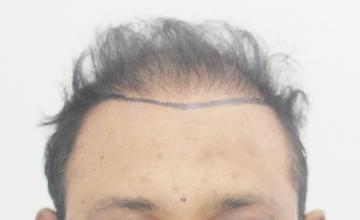 6 months corrective hair transplant results with Dr. Suneet Soni - 4400 Grafts