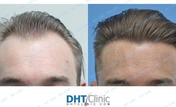 Dr. Damkerng Pathomvanich (DHT Clinic) / FUT 2180 grafts post-op 2 years