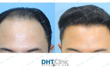 Dr. Damkerng Pathomvanich (DHT Clinic) / Combo(FUT+FUE) 2,883 grafts post-op 10 months