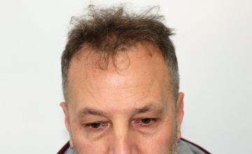 Dr Resul Yaman Hair Clinic - 4760 Grafts 2 Years Result