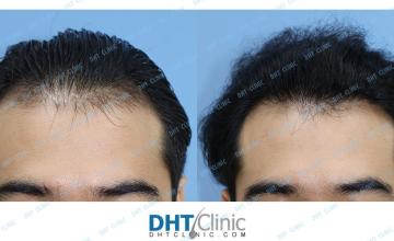 FUE session in G6PD deficient patient
