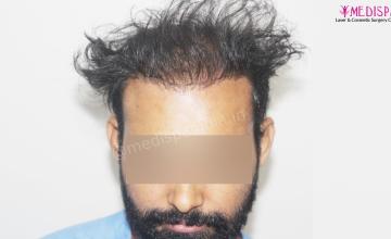 Revision Hair Transplant - 5111 Grafts / 5 Years Result - Dr. Suneet Soni, Medispa India