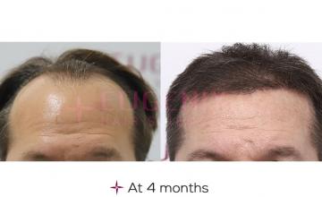 6 Months Hair Transplant Update | Hairline Restoration | Grafts 3287, Norwood Grade 5A @Eugenix Hair Sciences