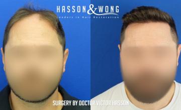 Hasson and Wong / Dr. Hasson / 5,225 grafts / FUE / frontal zone and mid-scalp / meds for crown / 1 year post-op
