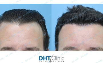 Dr. Damkerng Pathomvanich (DHT Clinic) / FUE 2,278 grafts, 8 months post op