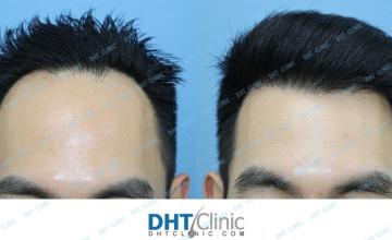 Hairline Restoration in Asian Male