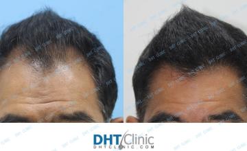 Dr. Damkerng Pathomvanich (DHT Clinic) / Combination of FUT and FUE 3,093 grafts to the front and crown, 7 months post op