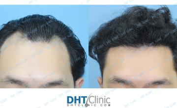 Dr. Damkerng Pathomvanich (DHT Clinic) / FUE 2,120 grafts to the front, 5 months post op