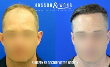 Dr. Hasson /4,903 Grafts/ FUE/ 1 Session/ 1 year post-op