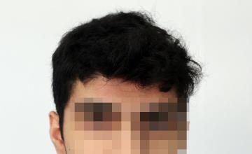 Dr Resul Yaman Hair Clinic - 2890 Grafts - 9 Months Result