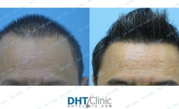 Dr. Damkerng Pathomvanich (DHT Clinic) / A combination of FUE and FUT with a total of 4,621 grafts in Asian, male