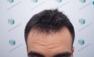 DR. Rafael de Freitas - 2804 Grafts / 6822 Hairs - FUE