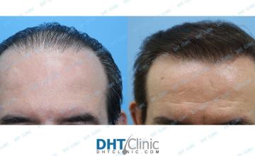 Dr. Damkerng Pathomvanich (DHT Clinic) / 3rd session using Combination of FUT and FUE beard grafts (3000 grafts), 1 year and 2 months post op