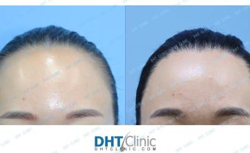 Female FUT transplantation