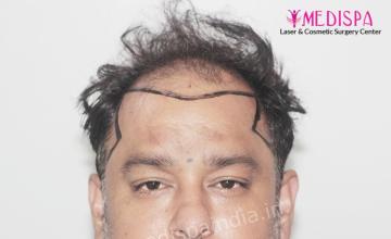 Dr. Suneet Soni - 5000 Grafts, Combine FUT + FUE + BHT (Beard) Technique, NW-V, 2.5 Year Result