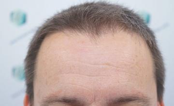 Dr. Rafael de Freitas - 2759 Grafts / 6049 Hairs - FUE