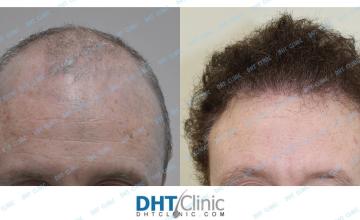 Two Sessions of Hair Transplantation