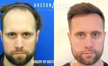 Dr. Hasson / 4228 grafts / FUE / 1 session / Hairline-Frontal Zone-Mid / 1 year post-op