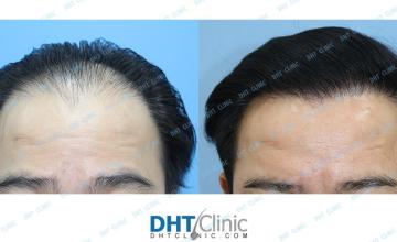 FUT 2470 Grafts + Oral Minoxidil 5mg Daily