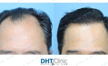 Dr. Damkerng Pathomvanich (DHT Clinic) / FUE in a 55-year-old Asian: 2,411 grafts, post-op 14 months