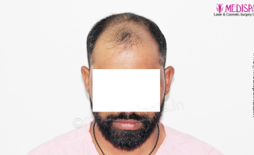 Dr. Suneet Soni - 5360 Grafts | 12-Month Result | Combination FUT + FUE + Beard