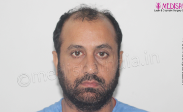 Dr. Suneet Soni - 5334 Grafts, Combine FUT + FUE + BHT (Beard) Technique, NW- V