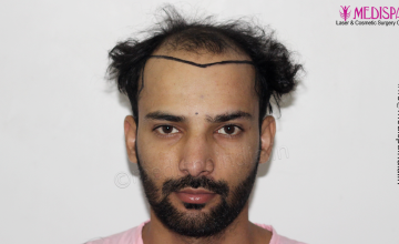 Dr. Suneet Soni - 4046 Grafts | 12-Month Result | Combination FUT + FUE + Beard