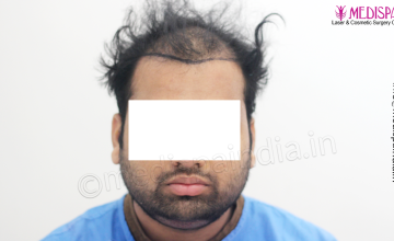 Dr. Suneet Soni - 5467 Grafts, Combine FUT + FUE + Beard Technique, NW- V, 3 Years Result