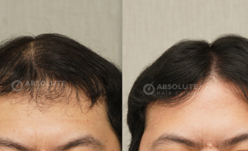 Dr. Kongkiat Laorwong, MD, FISHRS,  FUE 3560 grafts, 7 months post op