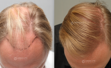 Dr. Kongkiat Laorwong, MD, FISHRS, FUE 3600 grafts, 2 years post op